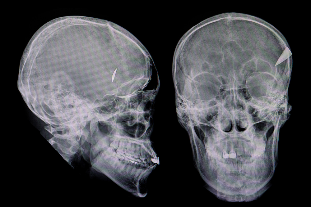 What is A Common Brain Injury from a Car Accident?
