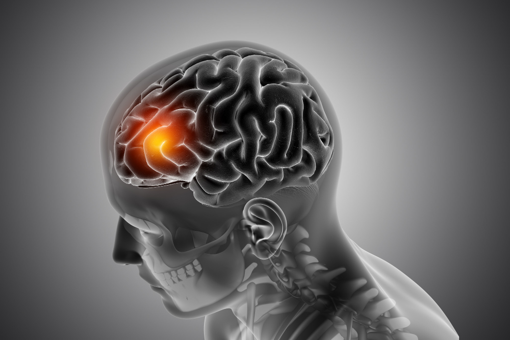 What Is the Average Settlement for a Traumatic Brain Injury Case?